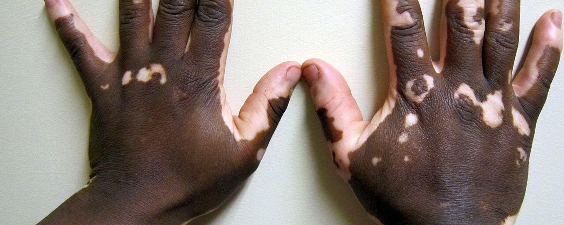 Vitiligo of the hand in a person with dark skin. - Sputnik India, 1920, 17.01.2023