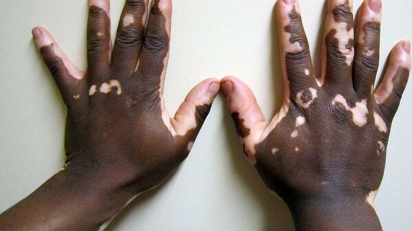Vitiligo of the hand in a person with dark skin. - Sputnik India