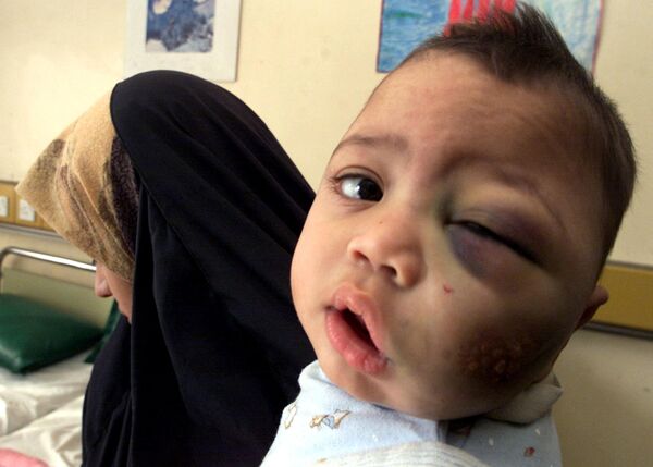 Ребенок с лейкемией, вызванной последствиями американских бомбардировок снарядами с обедненным ураном, в больнице Багдада, Ирак - Sputnik India