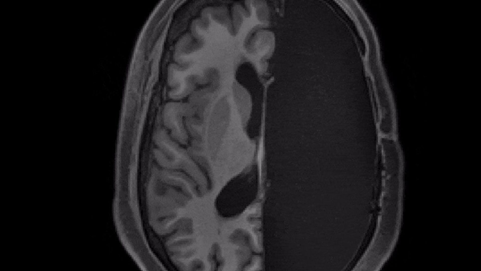 МРТ-сканирование пациента с одним полушарием головного мозга - Sputnik India, 1920, 19.05.2023