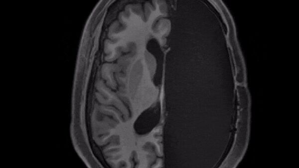 МРТ-сканирование пациента с одним полушарием головного мозга - Sputnik India