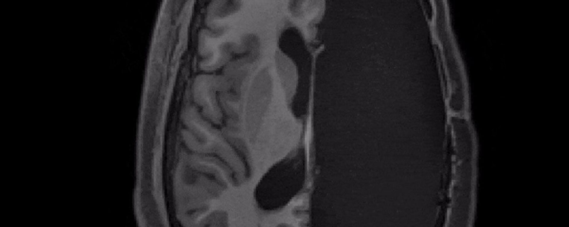 МРТ-сканирование пациента с одним полушарием головного мозга - Sputnik India, 1920, 19.05.2023