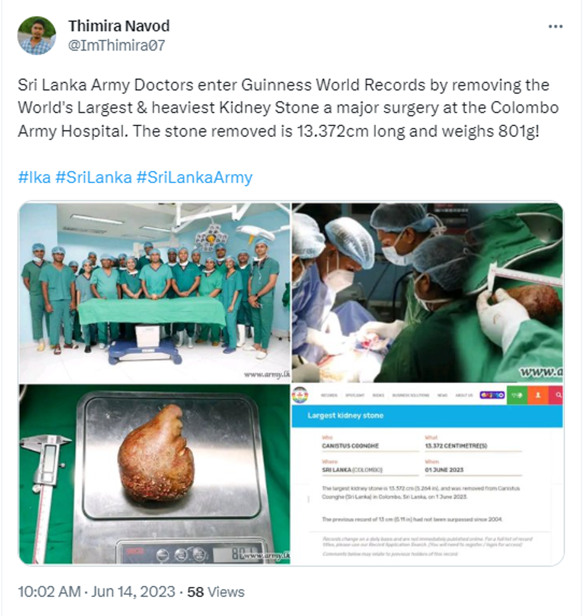 Sri Lanka Army Doctors Guinness World Records Removing World’s Largest Kidney Stone of 801gm   - Sputnik India, 1920, 14.06.2023