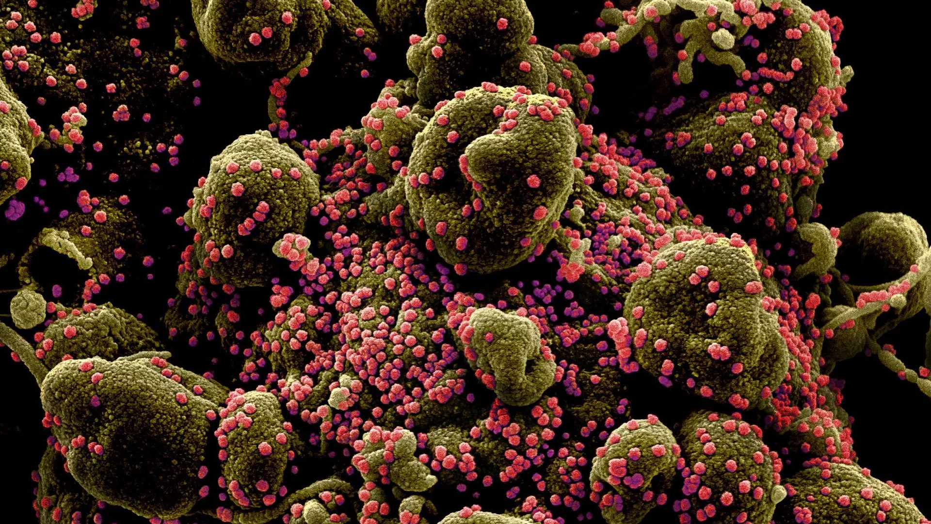 Colourized scanning electron micrograph of an apoptotic cell (greenish-brown) heavily infected with SARS-COV-2 virus particles (pink), also known as novel coronavirus, isolated from a patient sample. Image captured and colour-enhanced at the NIAID Integrated Research Facility (IRF) in Fort Detrick, Maryland.